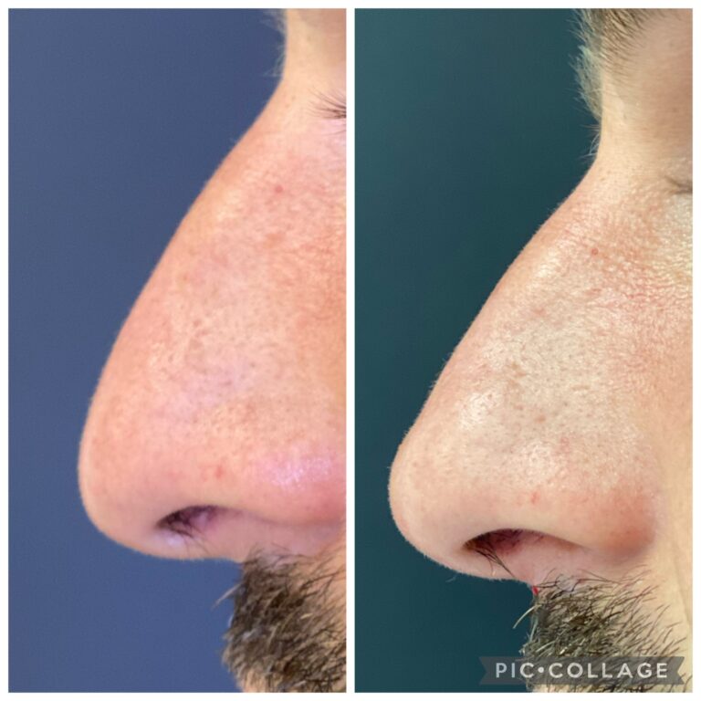 nicola_bianchi_medico_estetico_risultati_prima _e_dopo (23)